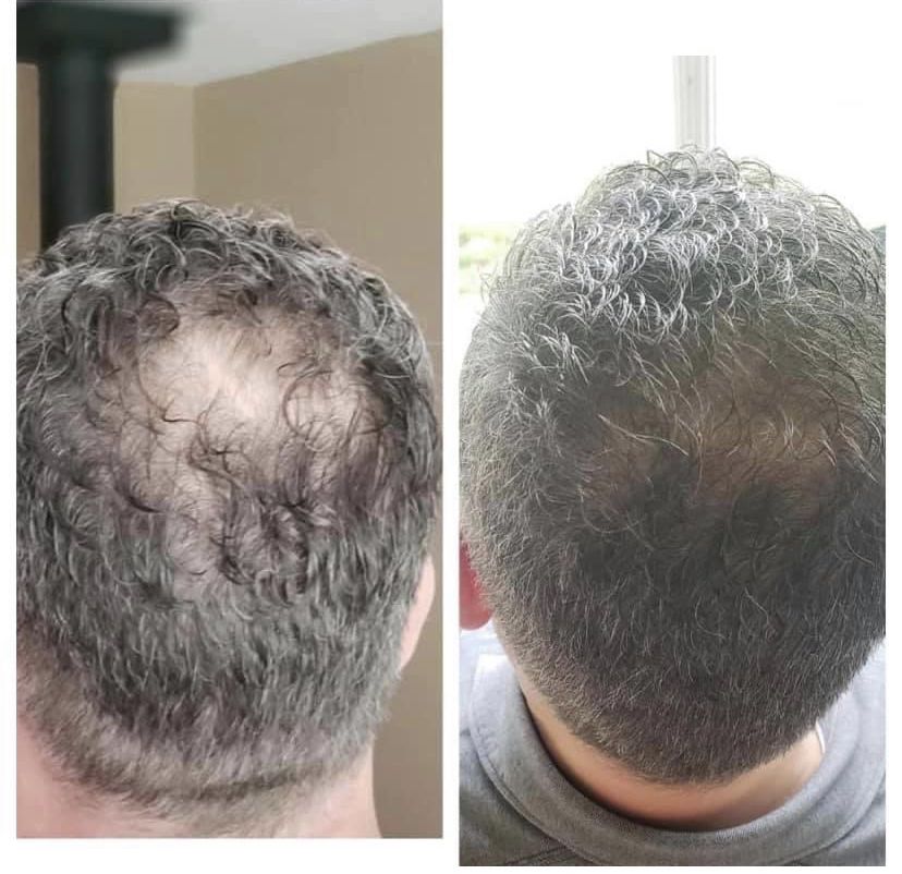 Recupera tu cabello, barba y cejas con el sérum #1 en República Dominicana